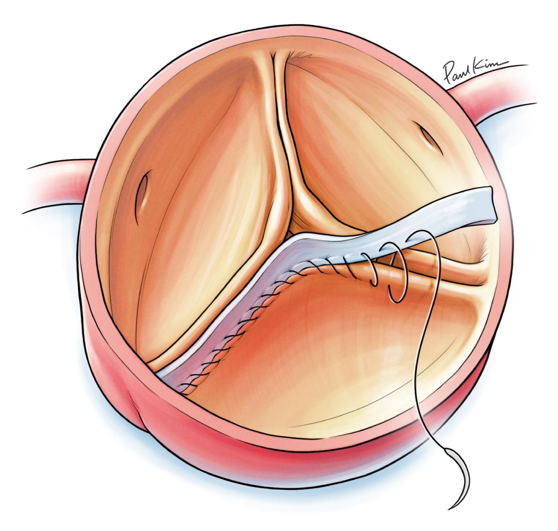 Aortic Valve Repair and Valve-Sparing Aortic Root Replacement | Adult ...