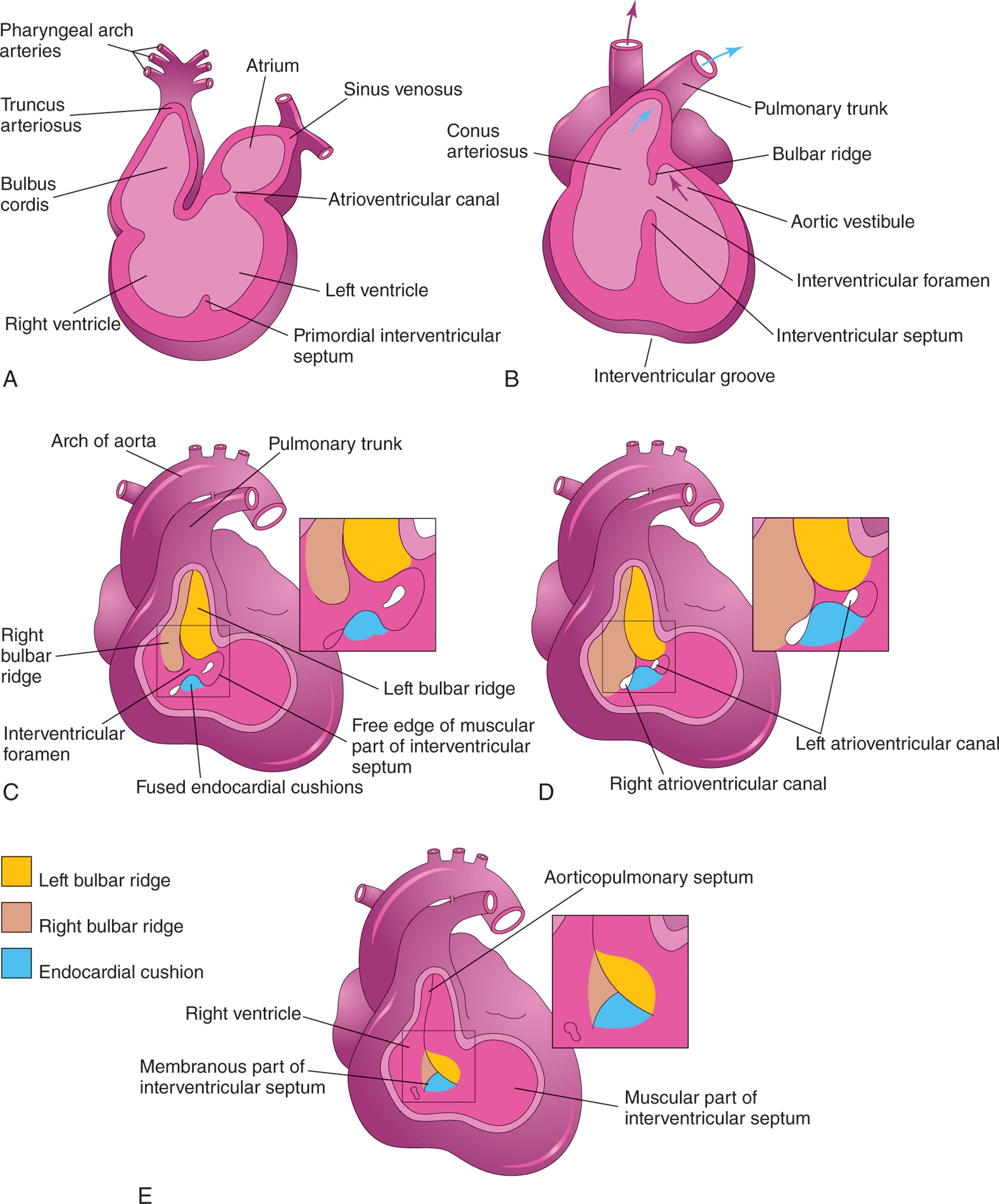 Ventricular Septal Defects (VSD) | Adult and Pediatric Cardiac